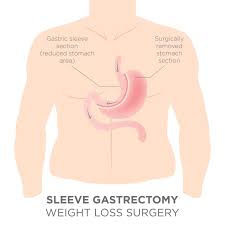 gastric sleeve surgery short and long