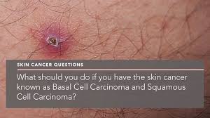 But, would you know if you were developing skin cancer? Skin Cancer Archives Penelope Pratsou Reading Dermatologist