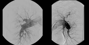 Do skupiny pah je řazena především idiopatická a hereditární pah a. Informace Pro Lekare Plicni Hypertenze