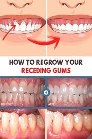 Gum recession can be prevented, stopped and reversed. How To Prevent Receding Gums From Getting Worse Arxiusarquitectura