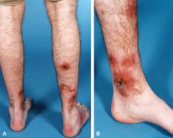 Image result for Panniculitis