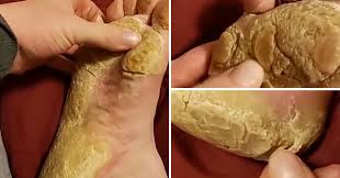 Calluses are thick and hardened layers of skin that usually occur on the hands and feet. Grim Video Shows Thick Yellow Skin At The Bottom Of Foot Metro News