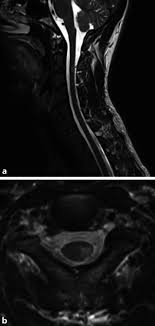 Krankheitsschübe wie auch läsionen in der magnetresonanztomographie (mrt) reflektieren den krankheitsprozess bei der… teriflunomid reduziert den jährlichen verlust an hirnvolumen frankfurt, 02. Inflammatory Spinal Cord Diseases And Transverse Myelitis Abstract Europe Pmc