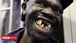 Traditional braces can straighten your teeth and boost your confidence, but they can also create other problems. Zimbabwe S Mr Ugly Contest Winner Too Handsome Bbc News