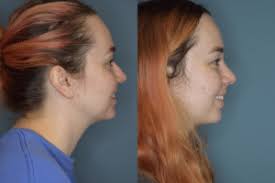 The epic partnership you've been waiting for. Nose Job Cost How To Get A Great Rhinoplasty Cheap Beverly Hills