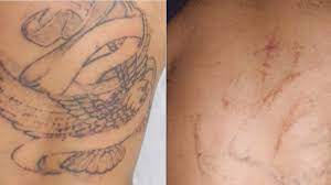 One tattoo was removed successfully with laser treatment, but the other required excision, which is a surgical removal. Tattoo Removal How To Costs Before And After Pictures More