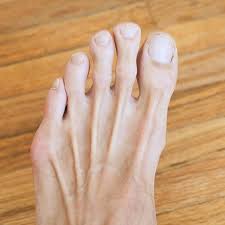 How To Get Rid Of Dark Toe Knuckles Remove Dark Spots Dark Spots On Legs Dark Spots Under Eyes
