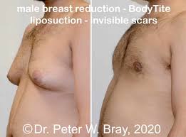 Dr. Feng Chong - Plastic Surgery Alberta - Although We Show Before And After  Pictures In The Office, We Rarely Post Them Online Because Everyone Is So  Different And Individual. However One