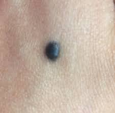 Image result for Blue Nevus
