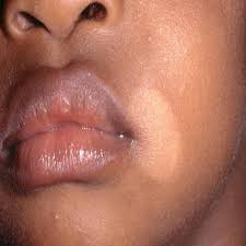 Image result for Postinflammatory Hypopigmentation