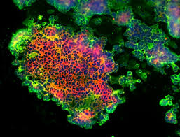Ovarian cancer is most common in the postmenopausal age group4. Targeting Faks To Treat Ovarian Cancer Elife Science Digests Elife