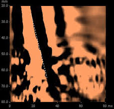 Racgp Fibroscan And Transient Elastography