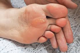 It is the terminal portion of a limb which bears weight and allows locomotion. Home Remedies To Treat Foot Corns