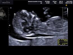 When the nt is greater than 3.5 mm, there is a 1 in 5 chance of a chromosome abnormality such as turner or down what does this mean? Diagnostic Ultrasound In The First Trimester Of Pregnancy Glowm