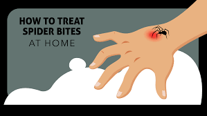 Is hydrocortisone cream good for spider bites? How To Treat Spider Bites At Home Insight Pest Solutions