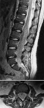 Conus Medulla Cauda Compression From Nerve Root Hypertrophy In A Child With Dejerine Sottas Syndrome Improvement With Laminectomy And Duraplasty In Journal Of Neurosurgery Spine Volume 97 Issue 2 2002