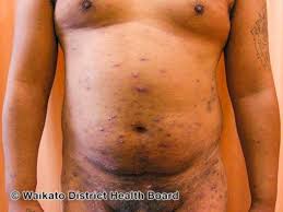 Image result for scabies in the groin area