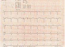 Qt Syndrom Wikipedia