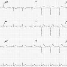 P wave = activation (depolarization) of atria. Pdf Miocardite Aguda Sob A Forma De Sindrome Coronariana Aguda Apos Infeccao Do Trato Urinario