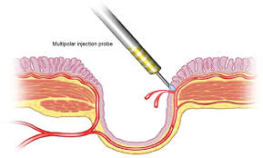 Image result for Diverticular Bleeding