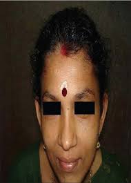 PDF] Zinc Deficiency Associated with Hypothyroidism: An Overlooked Cause of  Severe Alopecia