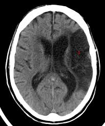 Cerebralt Infarkt Media Ct Laegehandbogen Pa Sundhed Dk
