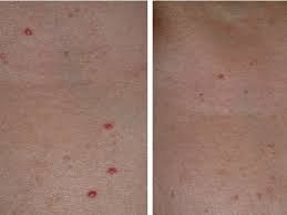 95 ($73.38/fl oz) free shipping. Cherry Angiomas Laser Treatment Lafayette La Renewed Med Spa