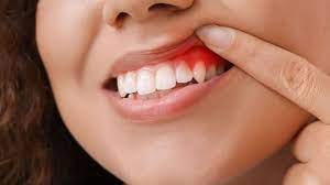 How To Prevent And Treat Gum Disease - Trublu Dentistry