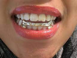 14k Gold Overlay Removable Gold Teeth Grillz By Myfamillystore Grillz Teeth Grills Teeth Fang Grillz