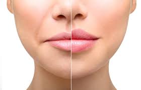 How To Reduce Swelling After Fillers | Dr. Semone Rochlin