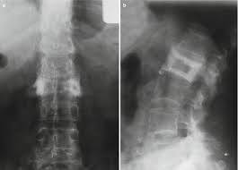 Frame picture photo camera border design photography gallery decoration. Paget S Disease Of Bone And Sarcoma Complicating Paget S Disease Musculoskeletal Key