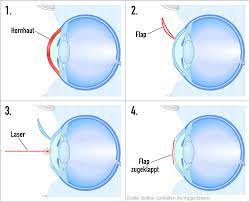 krankheiten von a bis z. Laser Behandlung Wie Funktioniert Die Augenkorrektur