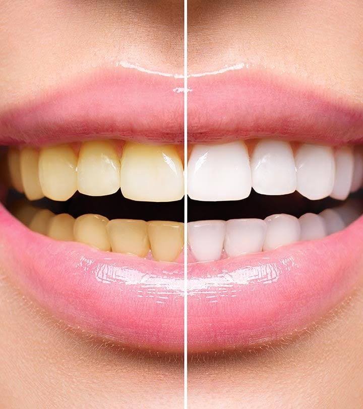 Teeth Whitening product image