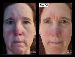 Has anyone tried adding hyaluronic acid to tallow lotion?