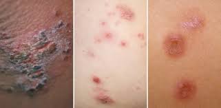 Impetigo Rash In Babies: Symptoms, Causes & Treatment