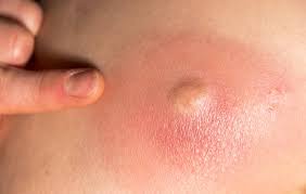 A cyst is a small sac filled with air, fluid, or other material. Lump On Neck Causes And Pictures
