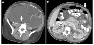 Axial Ct Images Through The Abdomen And Pelvis Of A Patient With Vp Download Scientific Diagram