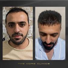 Haartransplantation vor und nach den Ergebnissen