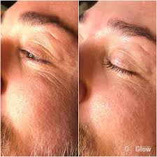 See more ideas about glow, skin treatments, led light therapy. Bbglow Treatment Permanent Make Up Schaefer