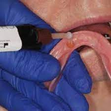 Check spelling or type a new query. The Denture Air Dried And Chairside Attachment Processing Material Download Scientific Diagram