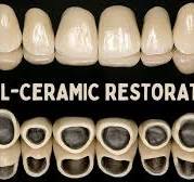 METAL CERAMIC RESTORATIONS - Herbert T. Shillingburg Jr