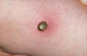 Image result for spinne biss haut reaktion