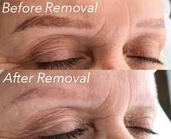 How to remove permanent makeup eyebrows saubhaya. Permanent Makeup Removal Color Correction Orange County Ca
