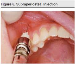 Image result for Periapical Block