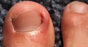 Image result for Onychotillomania feet