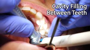 If your dark spots or holes are visible on your tooth, this means the cavity has gone untreated for a while and you should see a dentist right away. Dentist Filling A Cavity Between Teeth Youtube