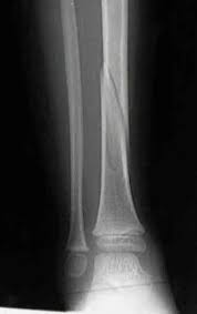 Check spelling or type a new query. Pediatric Tibial Fracture Wheeless Textbook Of Orthopaedics