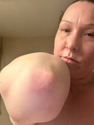 What are some effective treatments for psoriasis?