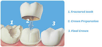 Check spelling or type a new query. Why Do I Need A Crown On My Tooth San Marcos Ca San Marcos Smile Dental