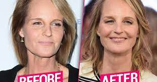 That is why she already been inside the entertainment industry for more than forty years when she is. Helen Unrecognizable After Plastic Surgery Makeover Top Docs Claim